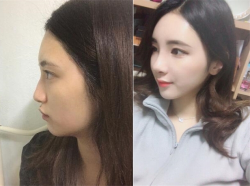 韩国丽丝塔短鼻矫正手术前后照片