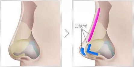 韩式肋骨隆鼻手术有什么优势和缺点？