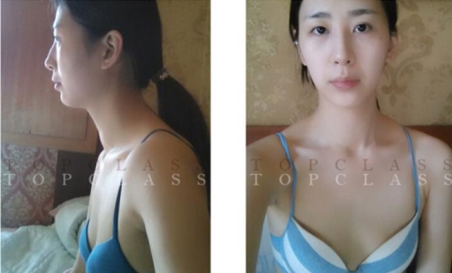 韩国TOPclass眼鼻隆胸手术术前照片