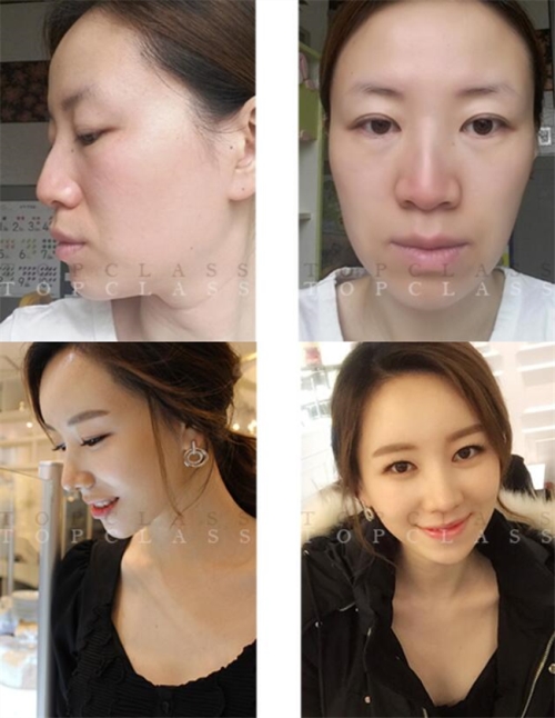 韩国topclass立体隆鼻+面部提升手术前后对比照片