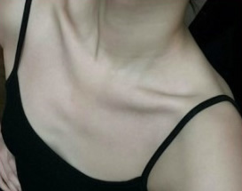 韩国GK整形外科隆胸术前照片