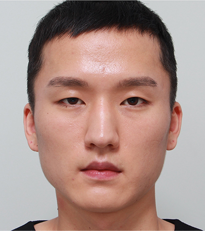 韩国男士整形手术案例对比