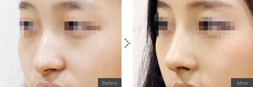 韩国olive整形外科隆鼻手术对比图