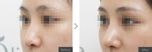 韩国olive整形外科自体软骨隆鼻案例效果