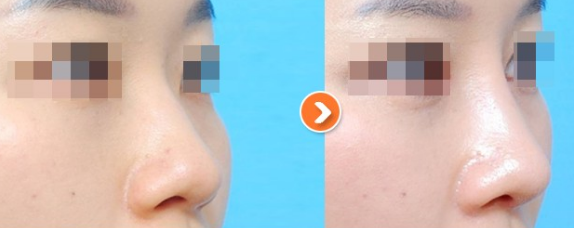 韩国icon整形做鼻子案例前后照
