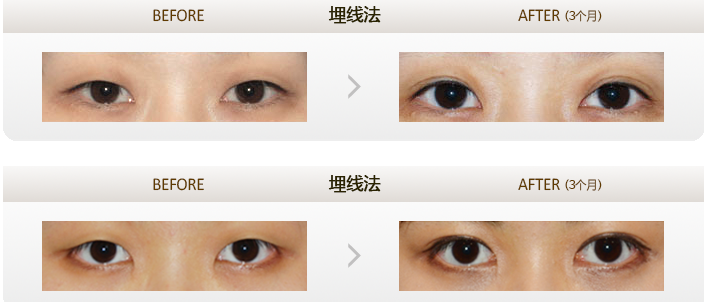韩国李康元双眼皮整形对比案例