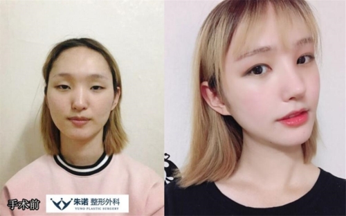 韩国朱诺整形眼鼻轮廓三件套手术前后照片