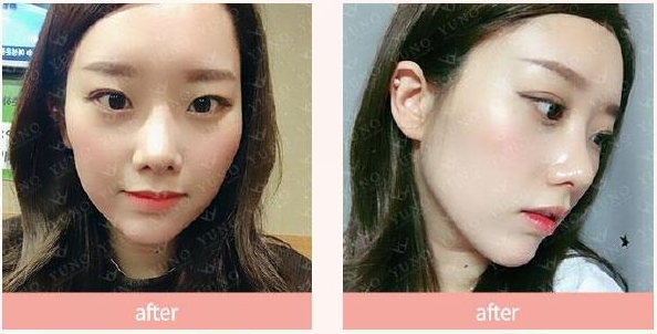 韩国朱诺鼻手术案例图