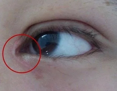 前眼角开的有括号的情况怎么办？疤痕好修复吗？