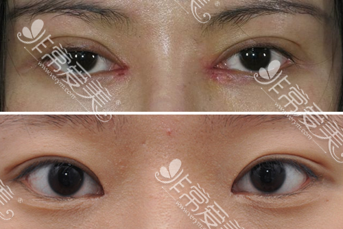 韩国医院开眼角疤痕修复案例对比
