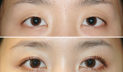 韩国耶斯整形外科双眼皮手术案例对比