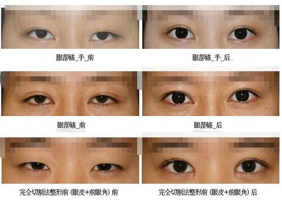 韩国耶斯整形网外科双眼皮修复案例