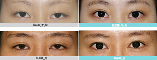 韩国耶斯整形外科双眼皮修复案例对比