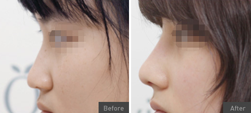 韩国olive整形外科蒜头鼻整形案例对比