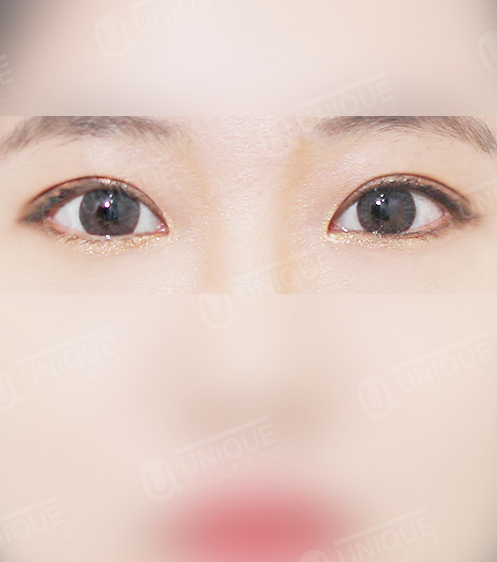韩国优尼克双眼皮手术效果图