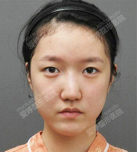 韩国爱婷医院眼鼻面部填充整形术前照片