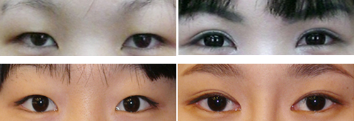 TS整形外科双眼皮案例对比