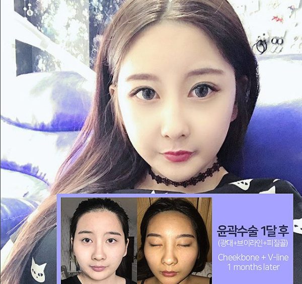 韩国now美面部轮廓手术案例
