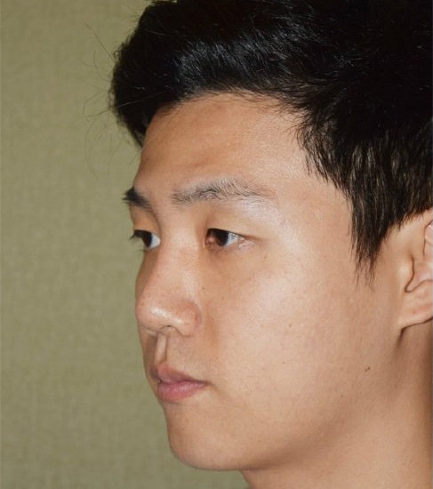 悬胆鼻标准照片 男性图片