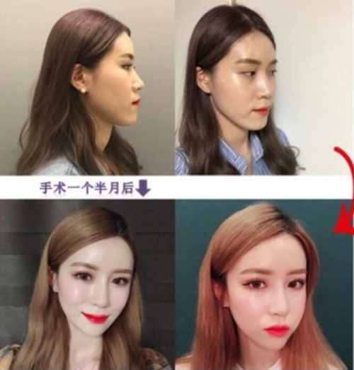 韩国NANA娜娜眼鼻综合全脸面部脂肪填充前后对比照片