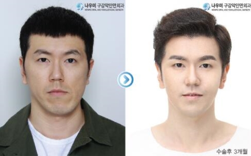 韩国NOW美整形医院面部不对称双鄂手术前后对比照片