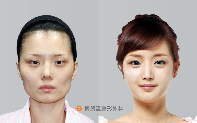 韩国博朗温鼻部整形案例对比