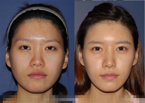 韩国李康元整形双眼皮修复前后对比照片
