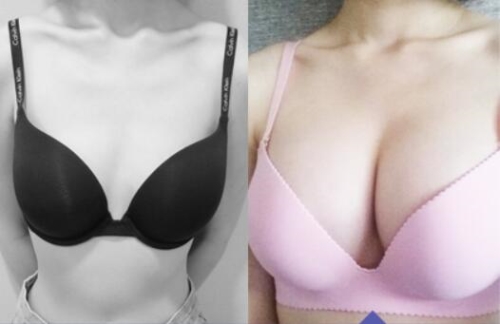 韩国Smile整形隆胸手术前后对比照片