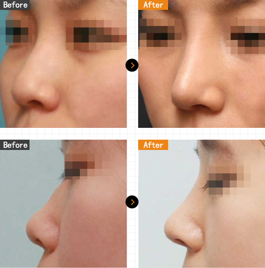 韩国玛博尔整形外科隆鼻案例