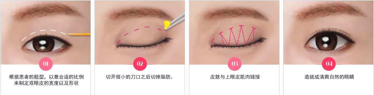 韩国jayjun埋线法双眼皮手术方式