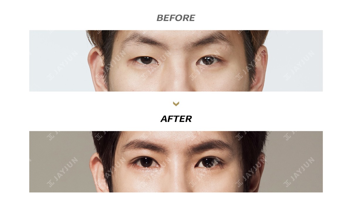 韩国jayjun男士双眼皮手术日记