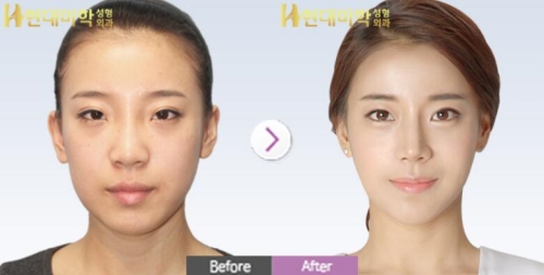 韩国现代美学眼鼻手术+面部轮廓整形前后照片