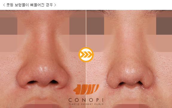 韩国高诺鼻修复案例图