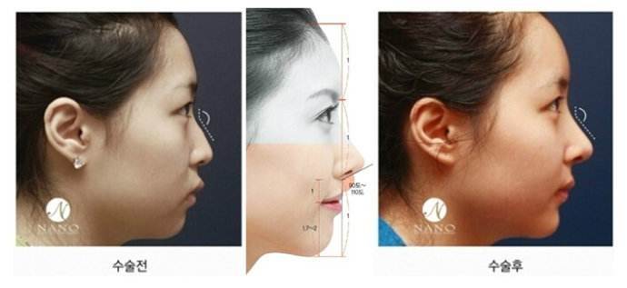 韩国nano整形外科鼻整形好吗
