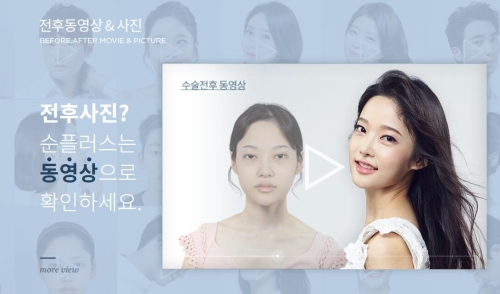 韩国soonplus双眼皮整形手术