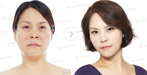 面部吸脂+双眼皮手术案例对比展示