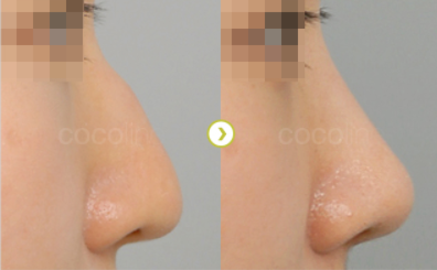 韩国cocoline整形外科隆鼻案例