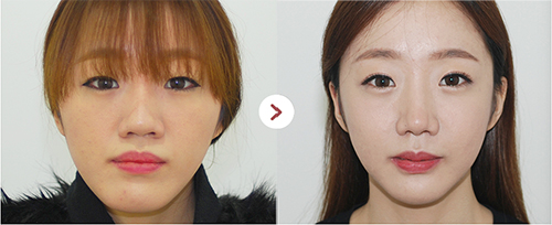 韩国爱宝整形医院和齐娥牙科比轮廓选谁？