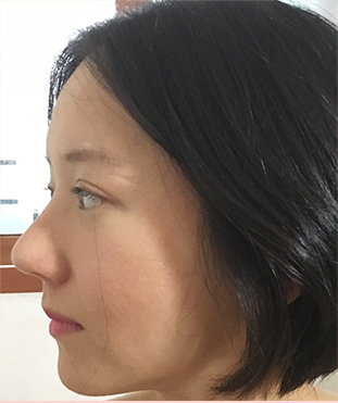 韩国jj整形外科隆鼻手术真人案例对比