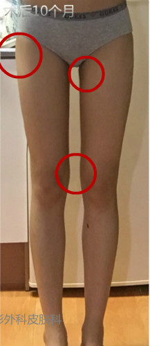 韩国丽妍k大腿吸脂案例