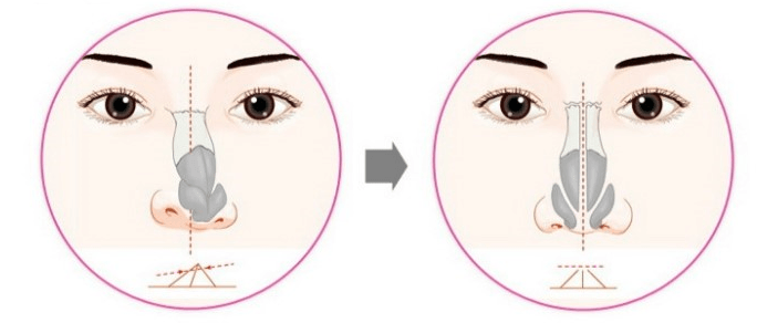 韩国鼻梁矫正手术方法示意图