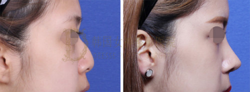 驼峰鼻整形手术案例对比