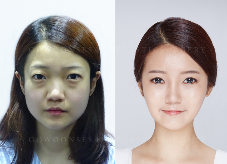 韩国德丽珍低鼻整形对比