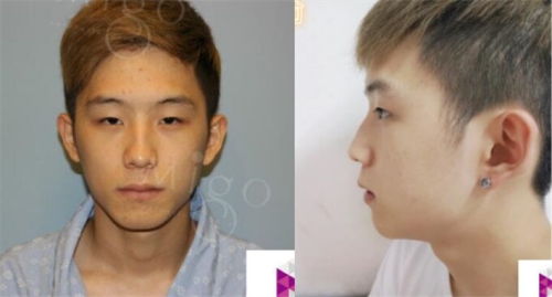 韩国MIGO医院男士眼鼻整形术前照片