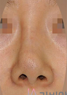 韩国拉菲安整形外科歪鼻矫正