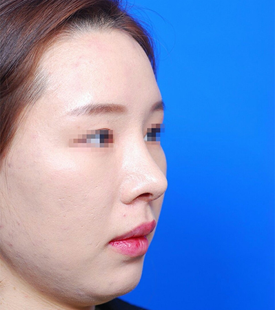 韩国柏恩隆鼻手术案例对比