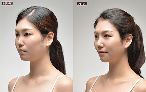 韩国dr朵做鼻子整形案例侧面45度照片
