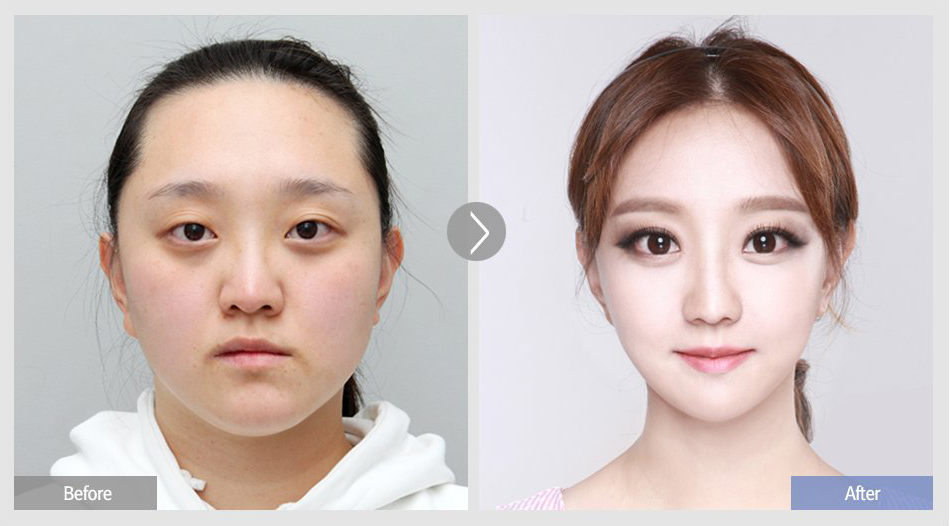 韩国菲斯莱茵整形外科双眼皮整形案例