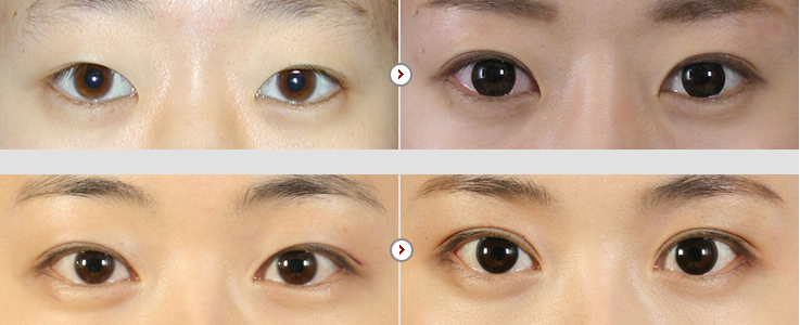 韩国爱婷整形外科双眼皮整形案例