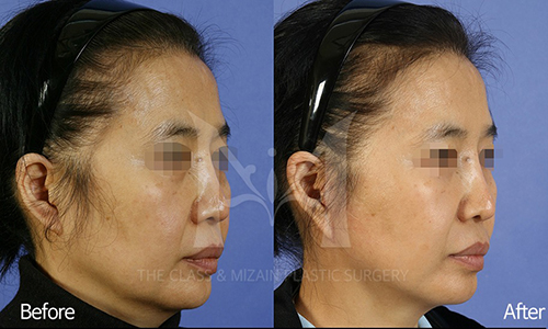 面部脂肪填充手术对比案例